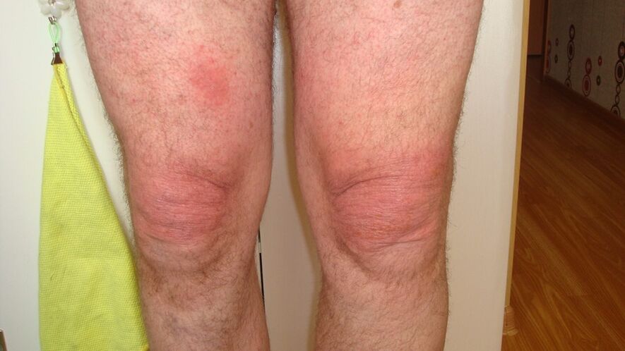 artroza stawów kolanowych